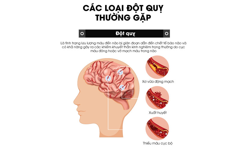 Các loại đột quỵ thường gặp