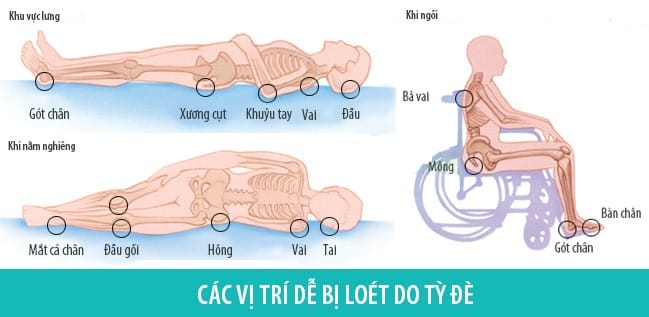 Các vị trí dễ bị loét tì đè
