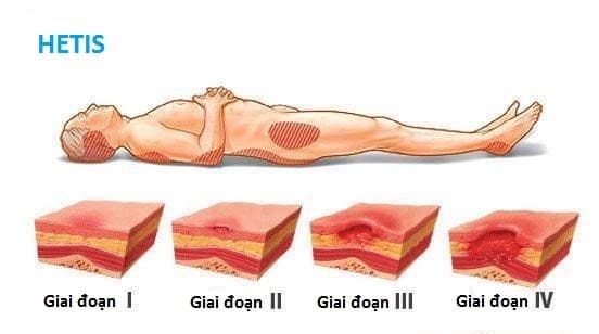 Tìm hiểu nguyên nhân gây ra vết loét do tì đè